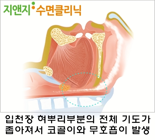 코골이