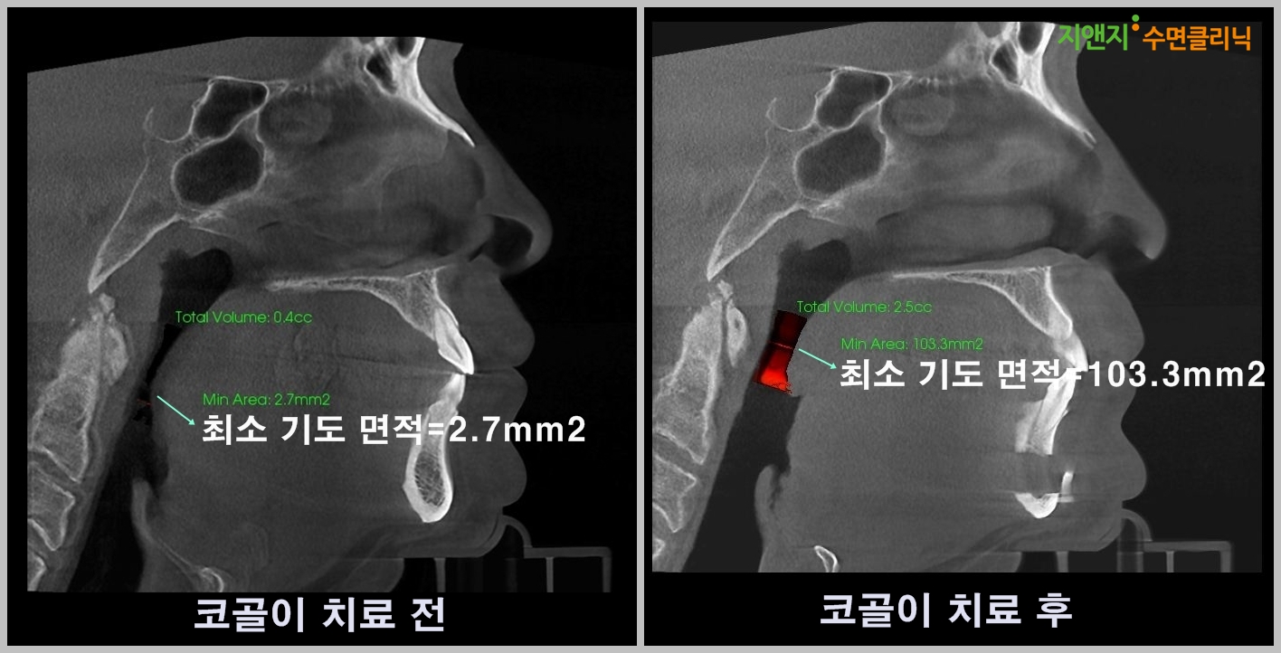 코골이 치료 3D CT