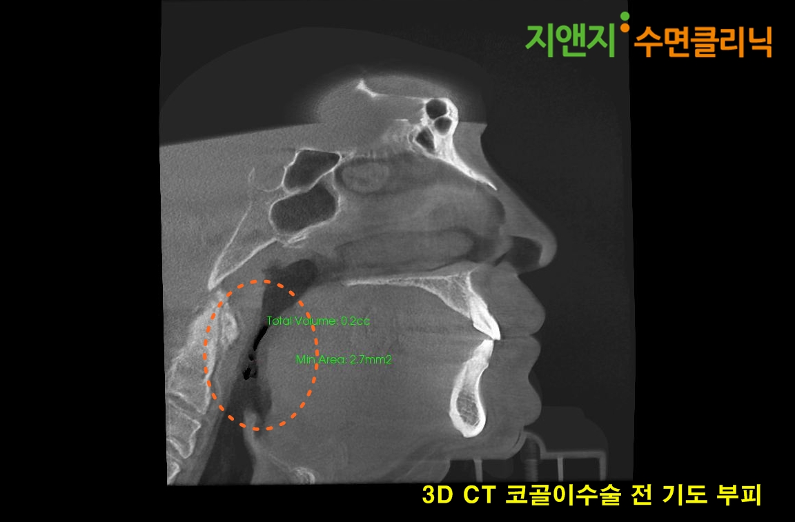 코골이수술 전 3D CT사진