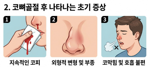 코뼈골절수술, 코뼈골절