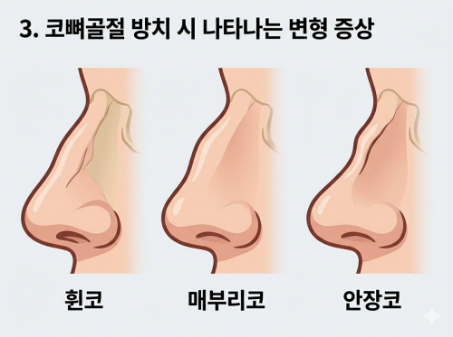 코뼈골절 방치 시 나타나는 변형 증상