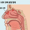 코뼈골절수술, 코뼈골절수술_1