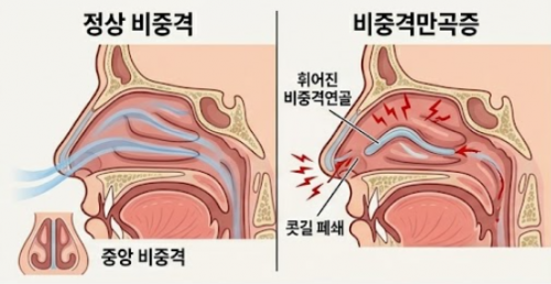 지앤지이비인후과 병원의 정상 코와 비중격만곡증 구조 비교 일러스트 1