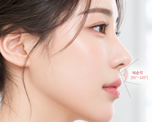 비순각교정 시 확인하는 코끝과 윗입술 사이 비순각 95~105도 측면 이미지