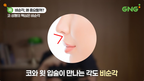 코와 윗입술이 만나는 비순각의 위치를 설명하는 지앤지병원 의료 영상