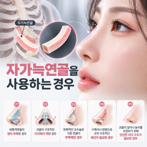 자가늑연골 사용을 고려하는 5가지 경우와 코끝 구조적 지지력 설명