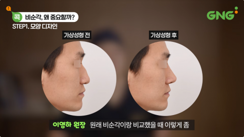 비순각교정 관련 코성형 전후 측면 코 모양을 비교하는 의료진 설명 영상