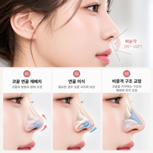비순각수술 시 코끝 연골 재배치와 연골 이식 및 비중격 구조 교정 방법