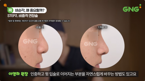 비중격 연장술 수술 전과 1개월 후 코끝 및 비순각 변화를 비교한 이미지