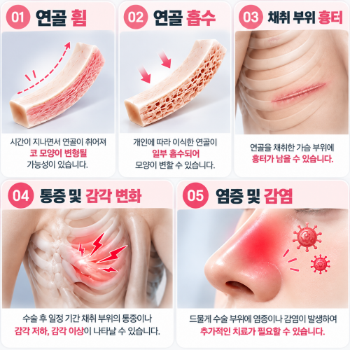 자가늑연골 이식 후 발생 가능한 연골 휨과 흡수, 흉터, 통증 및 염증 안내